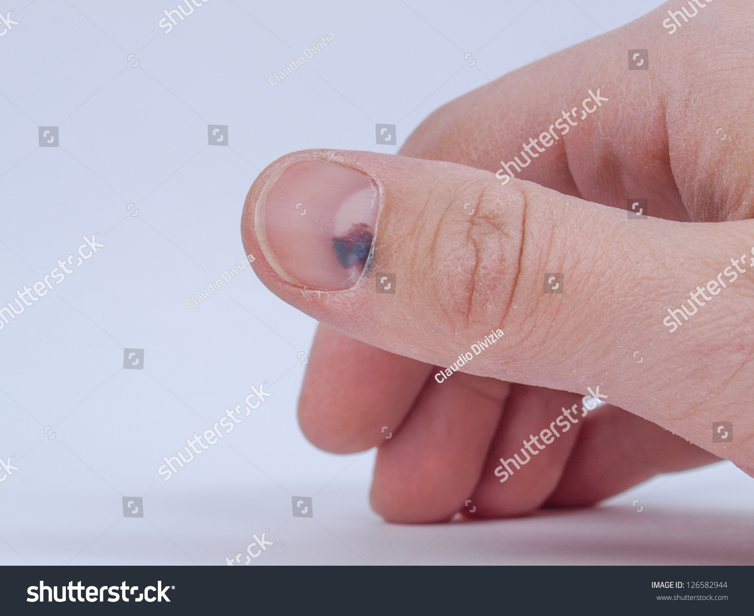 subungual hematoma fingernail icd 10