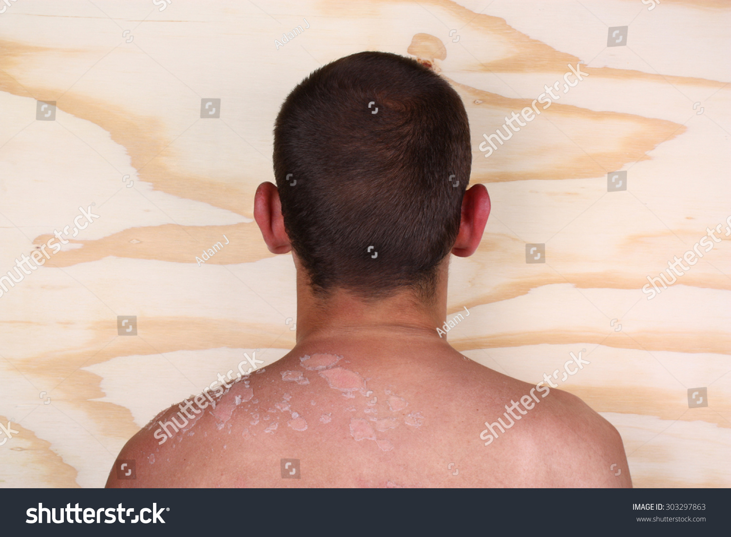 Sunburned Peeling On Back Body A Man Stock Photo 303297863 : Shutterstock