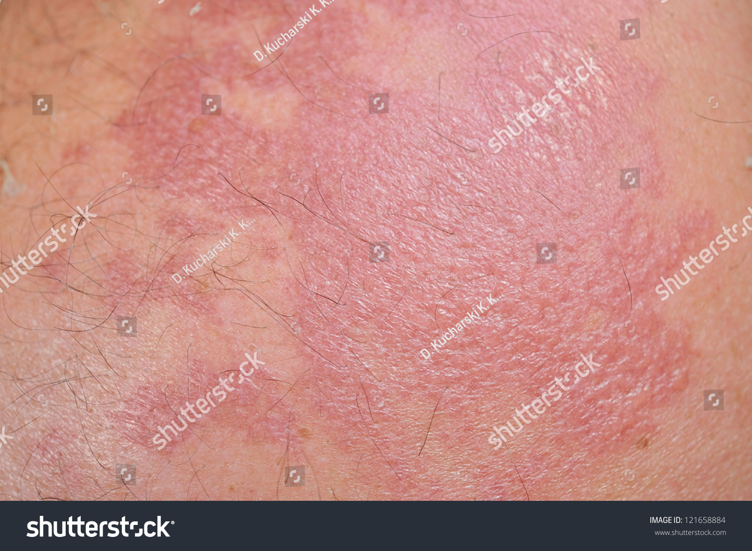 Sunburned Skin Stock Photo 121658884 : Shutterstock