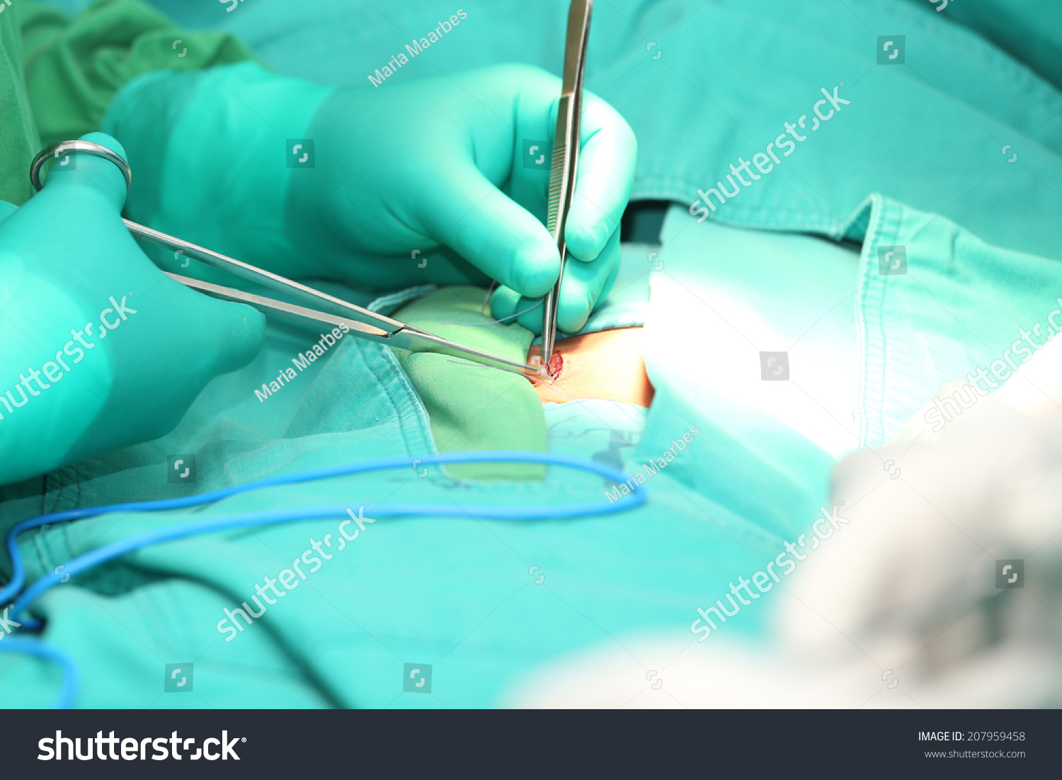 Surgeon Hands Suturing Hernia Stock Photo 207959458 - Shutterstock