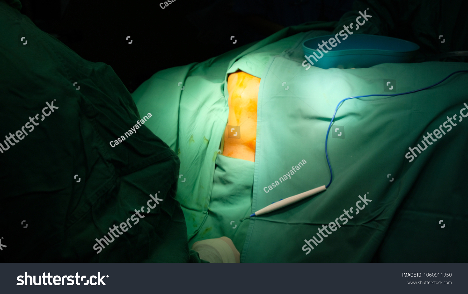 Surgeon Performing Surgery Removing Lipoma Operation Stock Photo (Edit ...