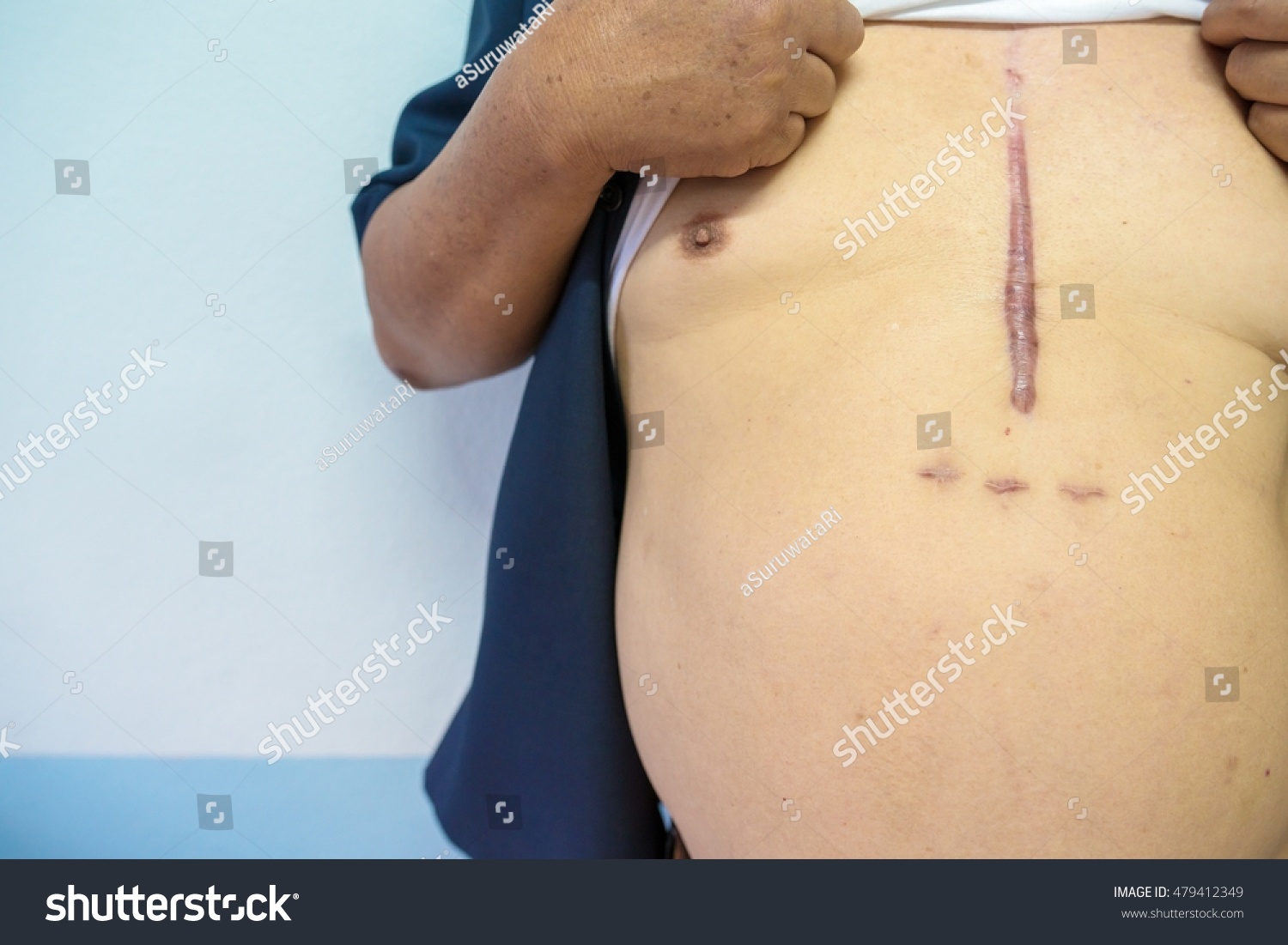 Surgical Scars After Surgery Heart Surgery Stock Photo Edit Now 479412349