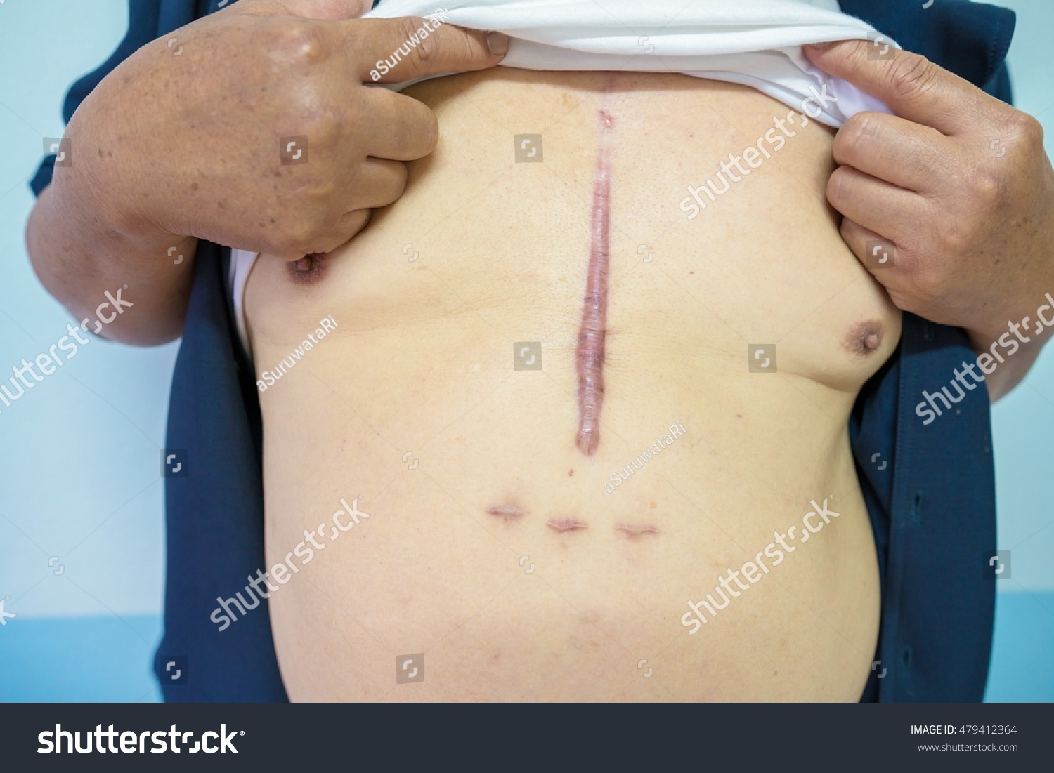 Surgical Scars After Surgery Heart Surgery Stock Photo Edit Now 479412364