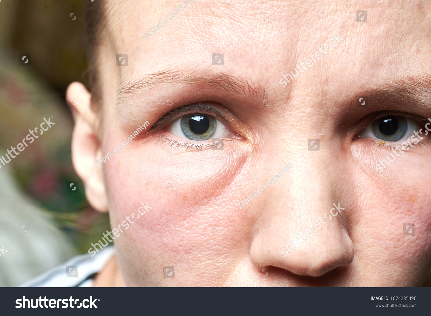 Swollen Face Woman Under Eyes Swelling Stock Photo Edit Now 1674285496