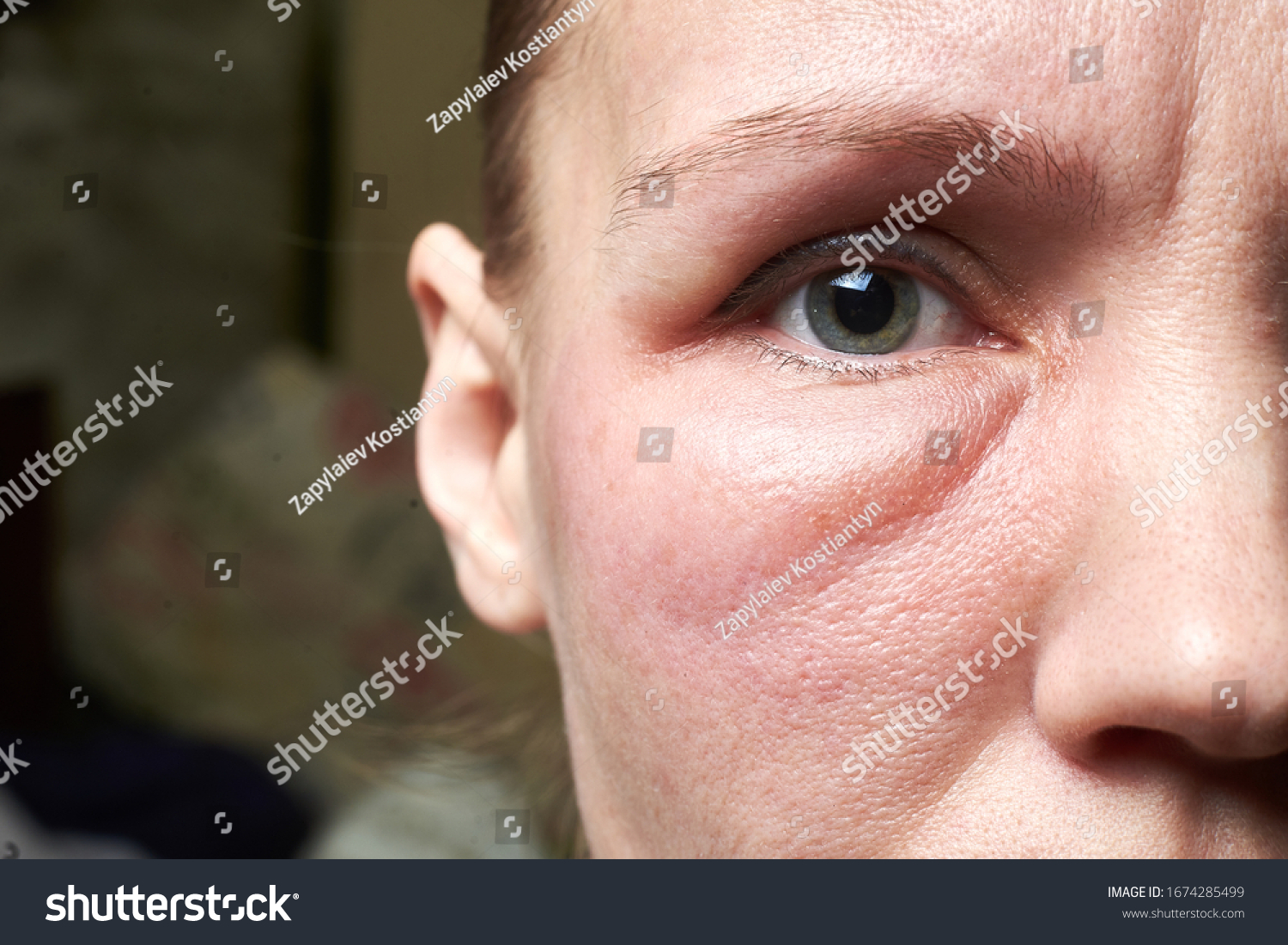 Swollen Face Woman Under Eyes Swelling Stock Photo Edit Now 1674285499