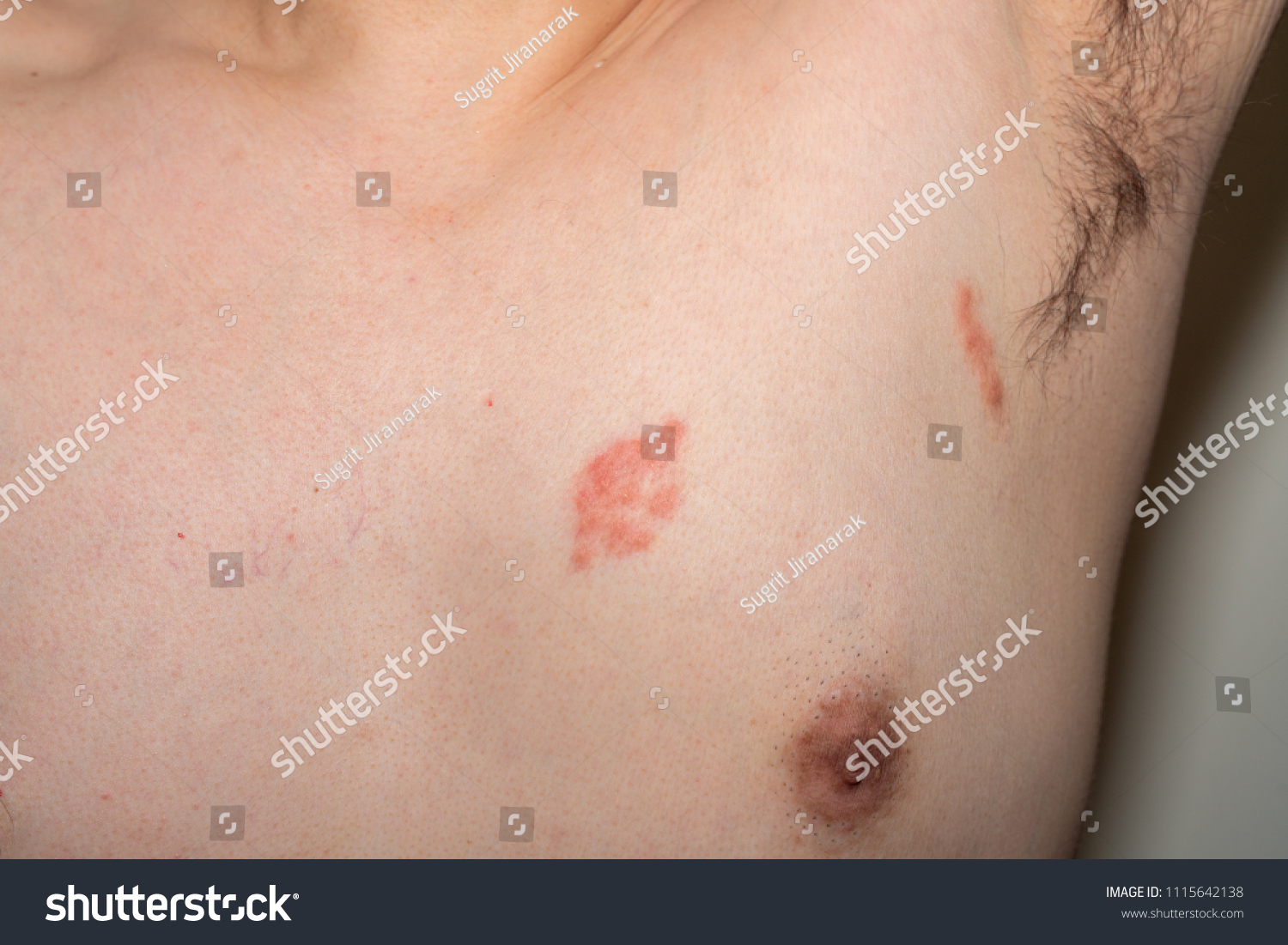 Apologise, herpes zoster on penis think Herpes zoster on penis opinion