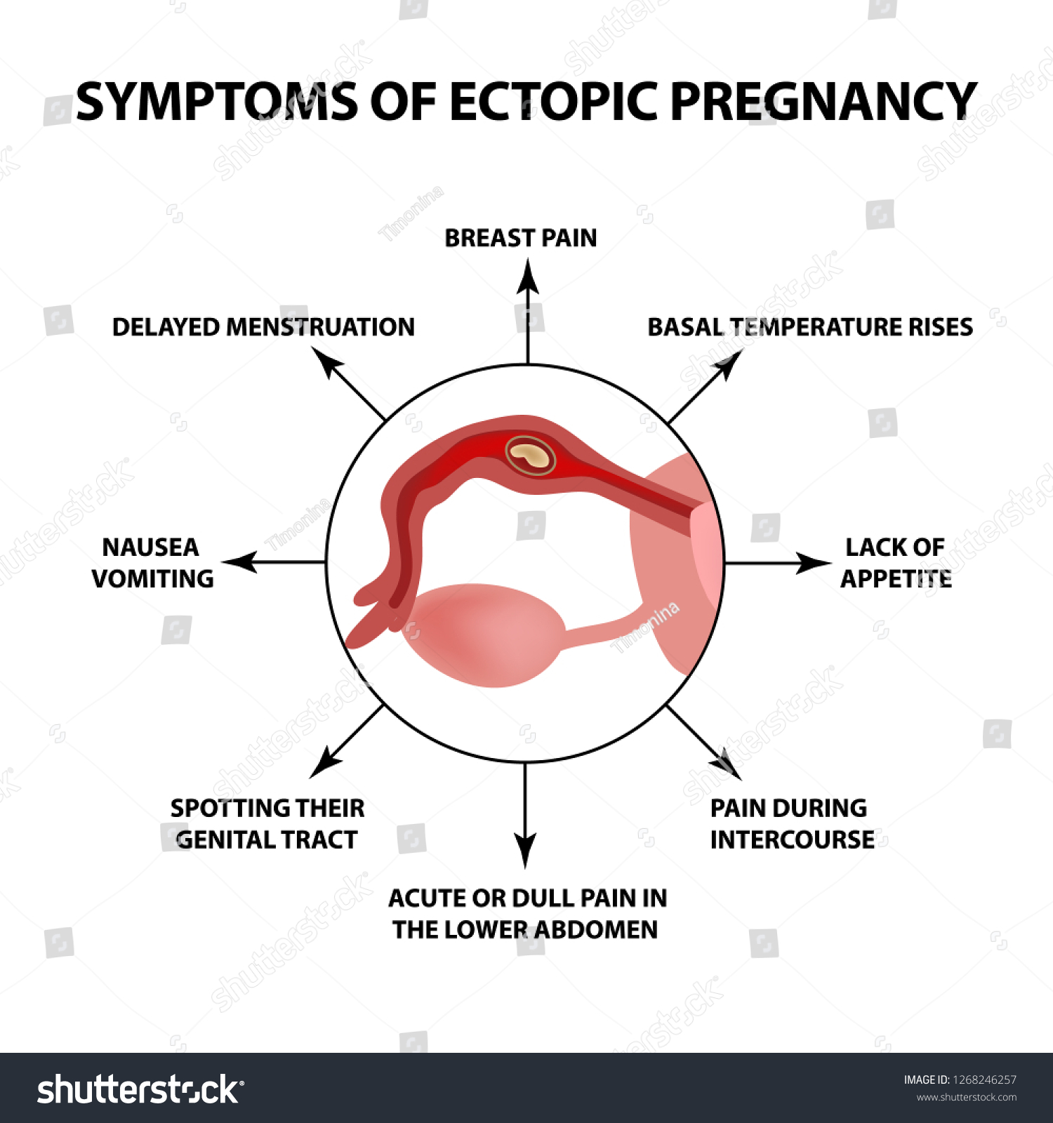 Symptoms Ectopic Pregnancy Infographics Illustration On Stock