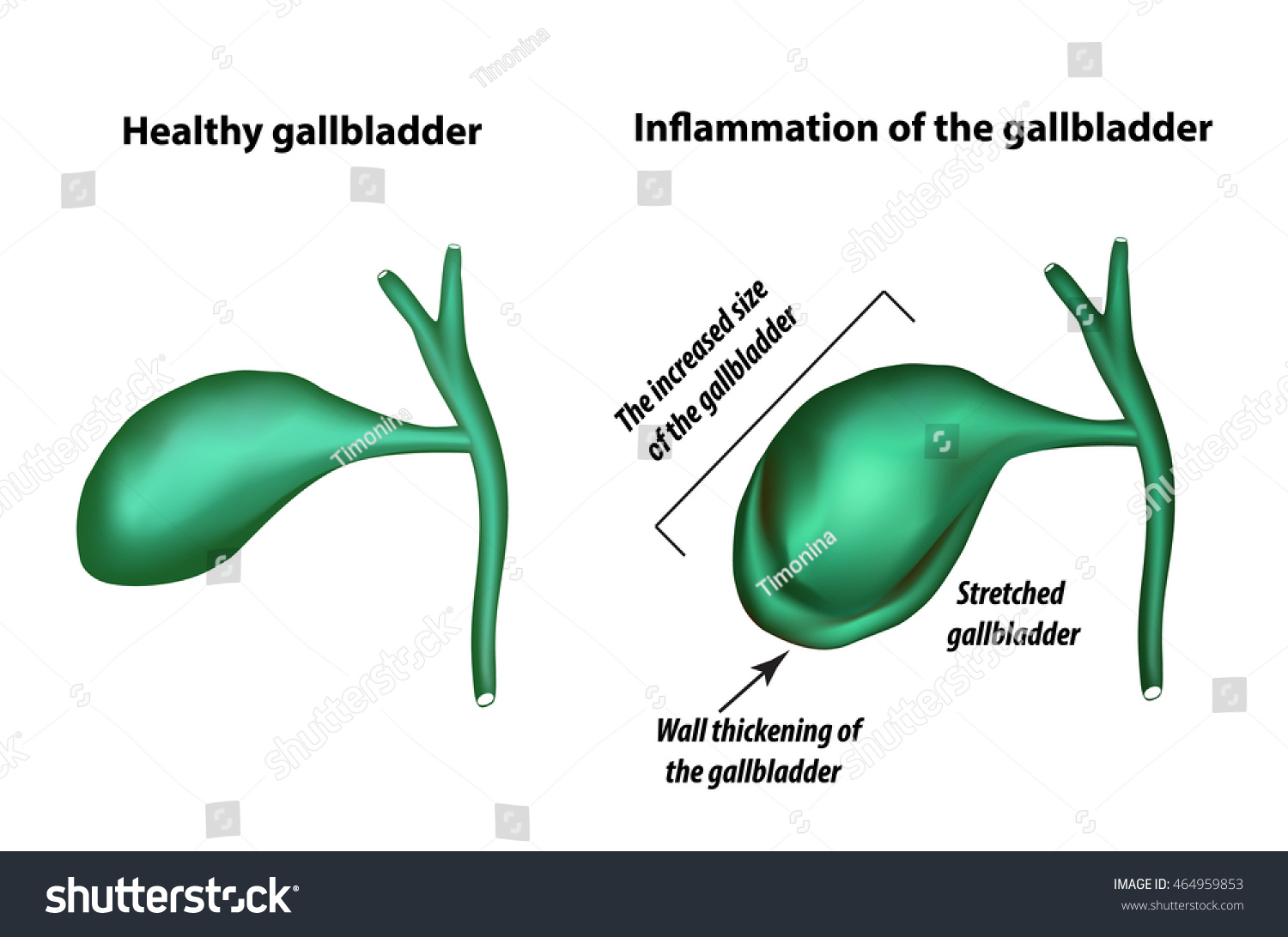 Bend of the gallbladder: causes, clinical manifestations, treatment Bend of the gallbladder: causes, clinical manifestations, treatment