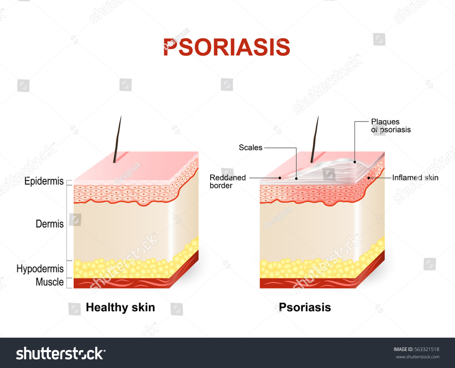 Normal Skin Vs Psoriasis