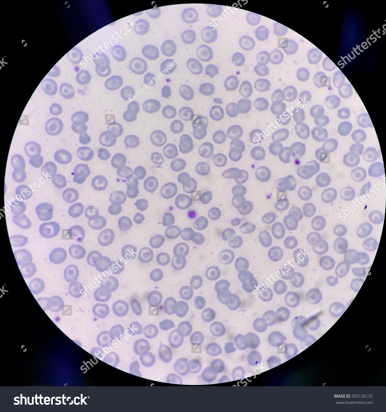 Target Cell Peripheral Blood Smear Stock Photo 593126135 | Shutterstock