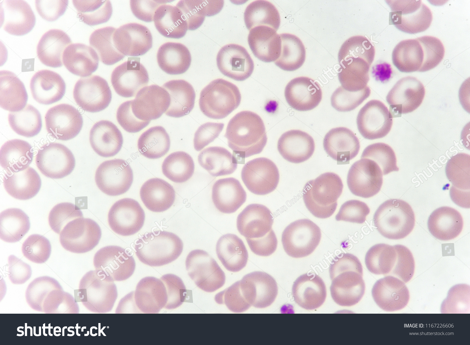 Target Cells Abnormal Red Blood Cells Stock Photo (edit Now) 1167226606