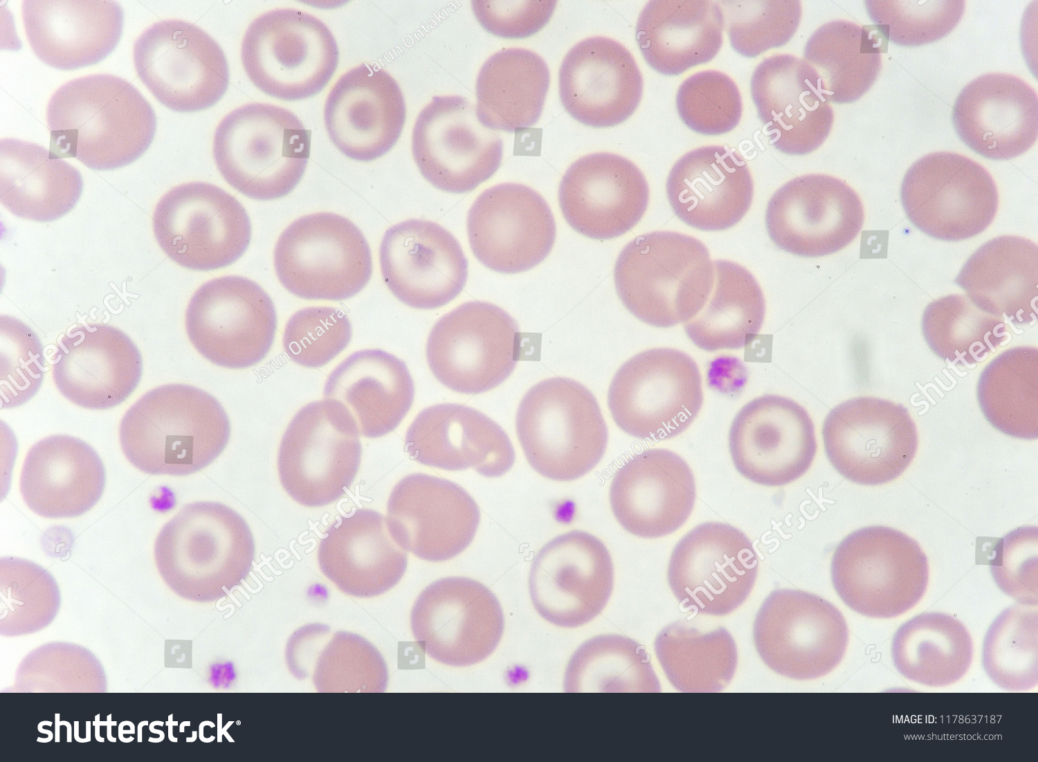 Target Cells Abnormal Red Blood Cells Stock Photo (Edit Now) 1178637187