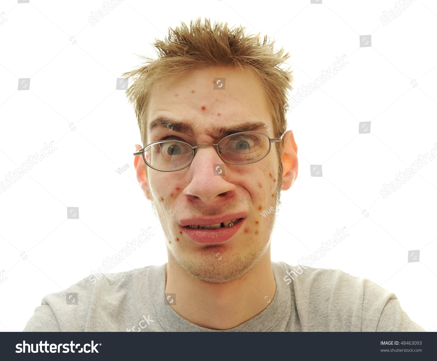 Teenage Looks Embarrassed Confused About Pimples Stock Photo 48463093 ...