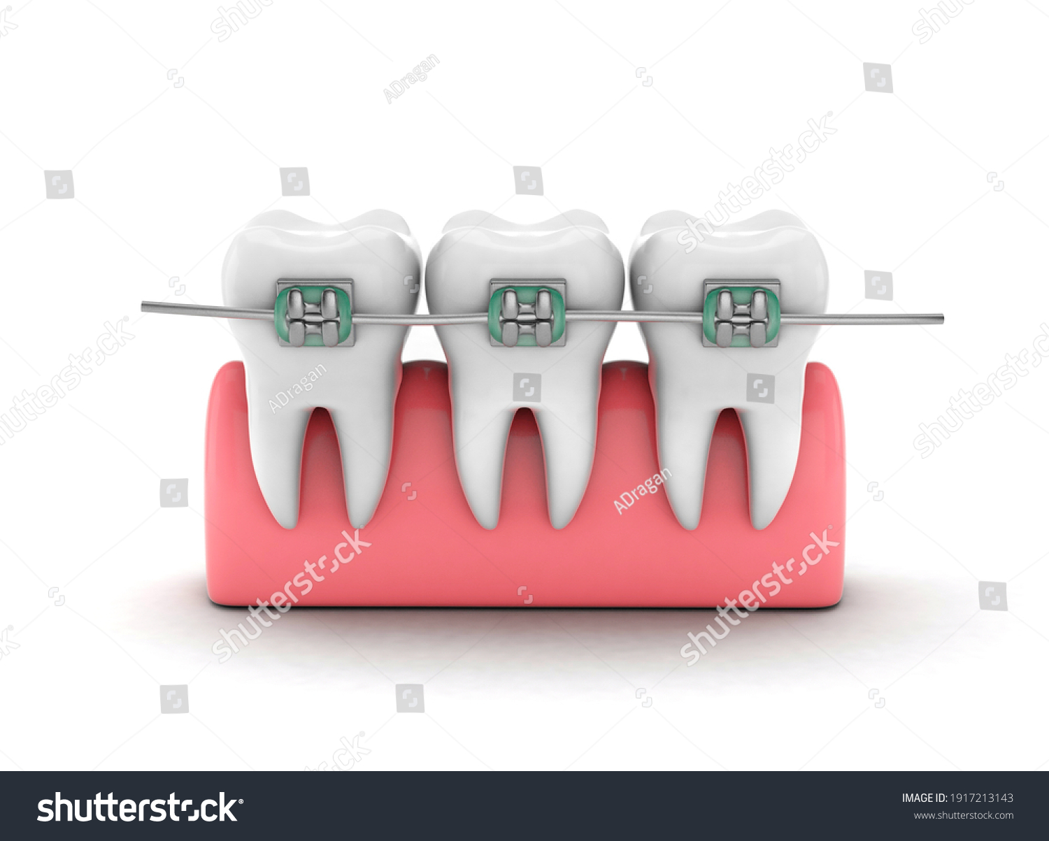 Teeth Braces Teeth Alignment Teeth Gum Stock Illustration 1917213143