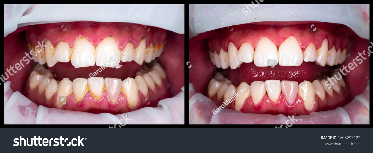 Kelsey Periodontal Group - Deep Cleaning of Teeth - Kelsey Periodontal Group