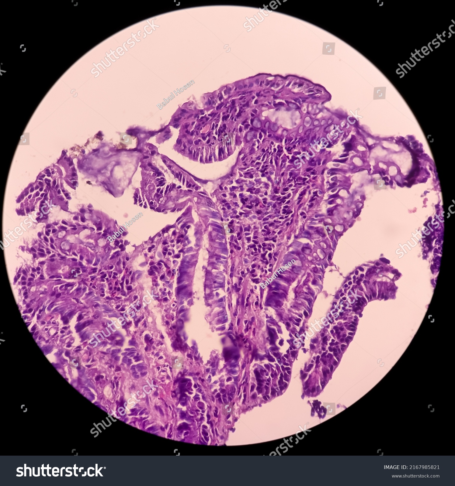 terminal-ileumbiopsy-chronic-nonspecific-ileitis-inflammation-stock