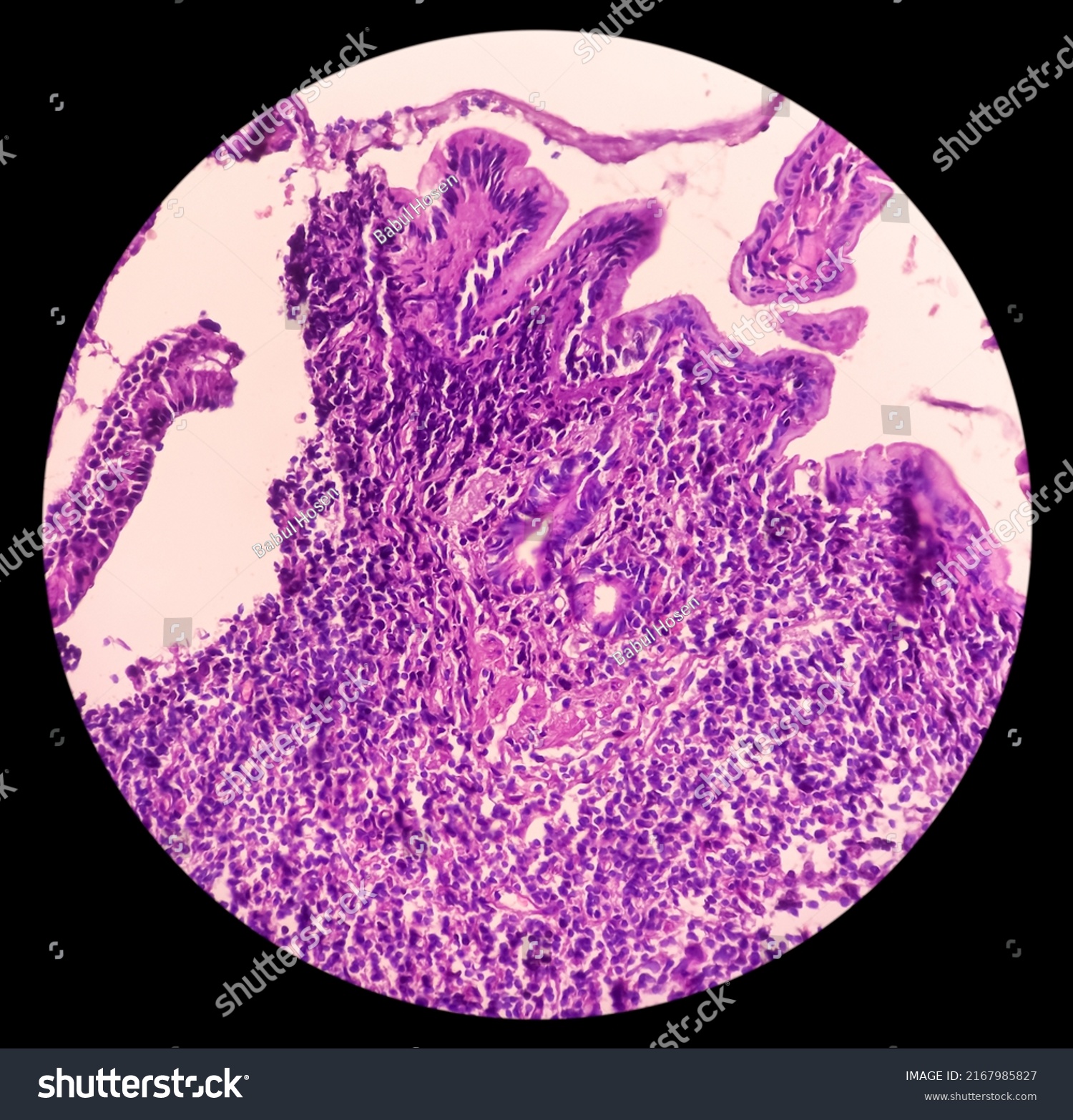 terminal-ileumbiopsy-chronic-nonspecific-ileitis-inflammation-stock