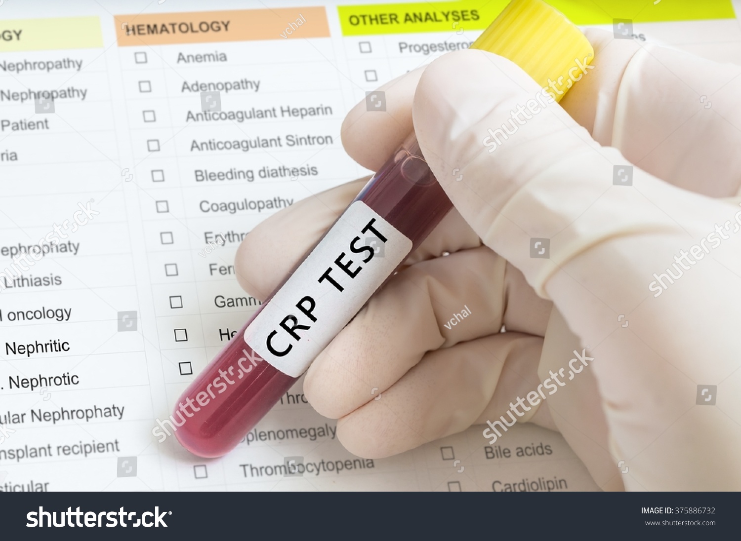 Test Tube Blood Crp Test Recognize Stock Photo 375886732 | Shutterstock