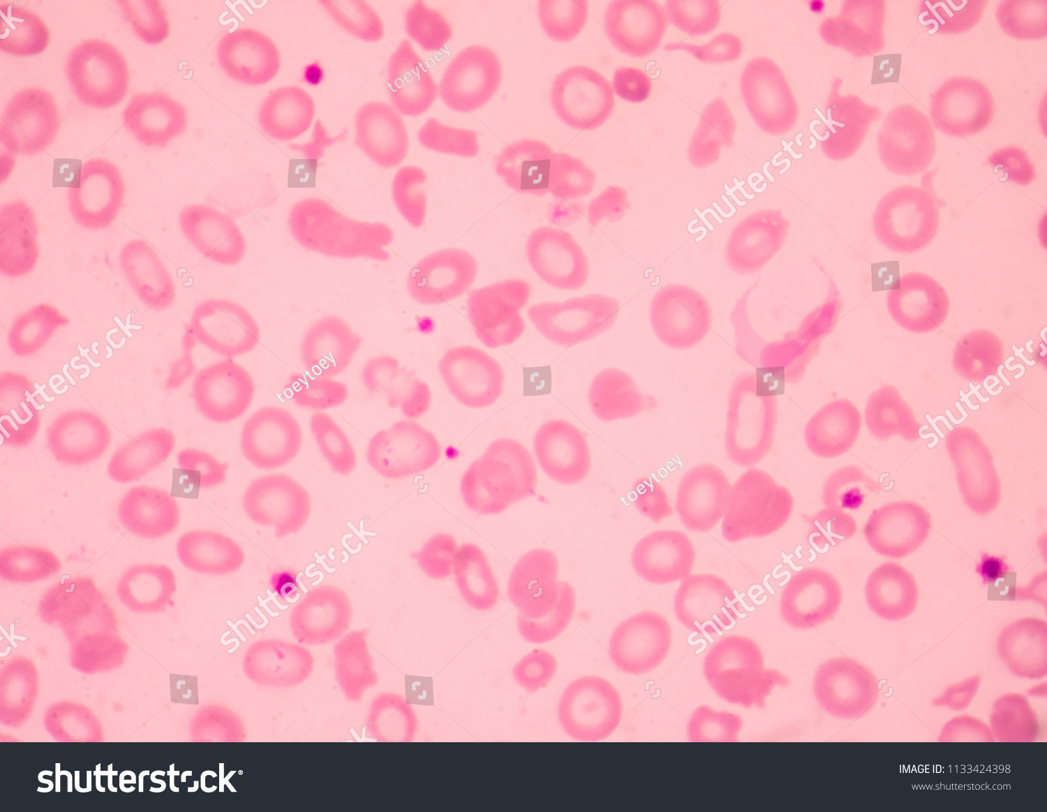 Thalassemia Blood Smear Abnormal Red Bloodarkivfotografi1133424398