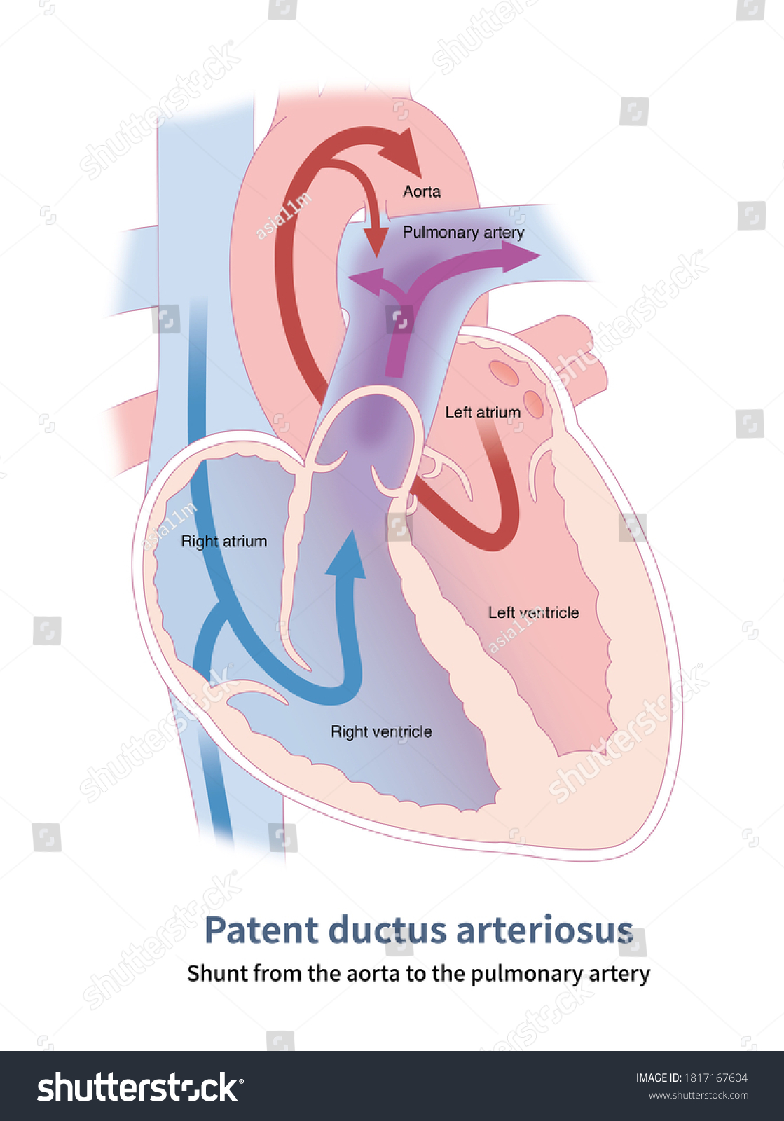 Aorta Shunts Pulmonary Artery Through Arterial