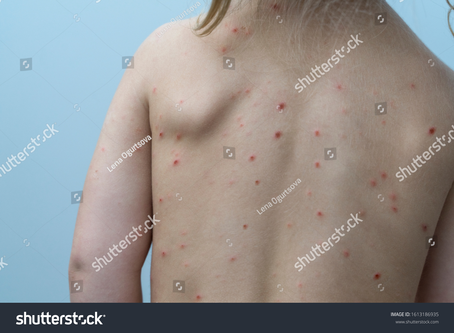 babys-back-covered-red-rash-chickenpox-stock-photo-1613186935