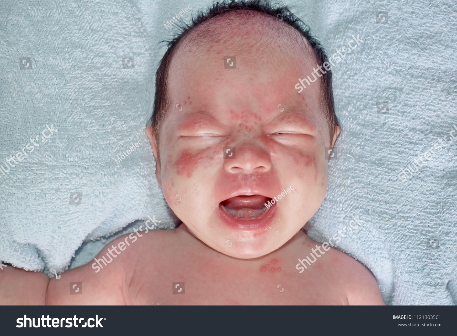 Babys Face Covered Rash Caused By Stock Photo Edit Now 1121303561