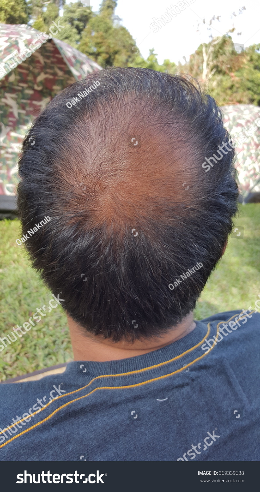 Bald Male Head Rear Thinning Hair People Healthcare Medical