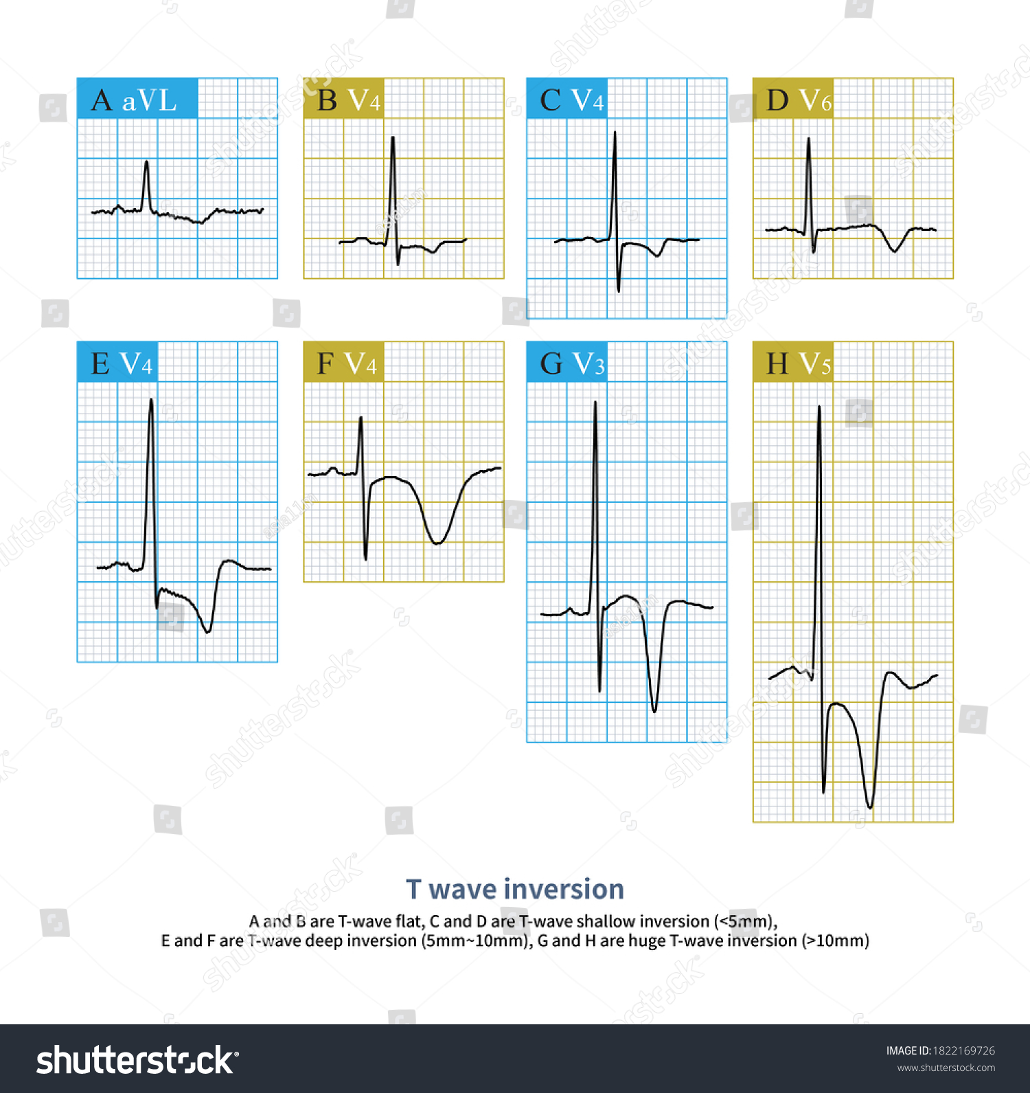 170 T wave inversion Images, Stock Photos & Vectors | Shutterstock