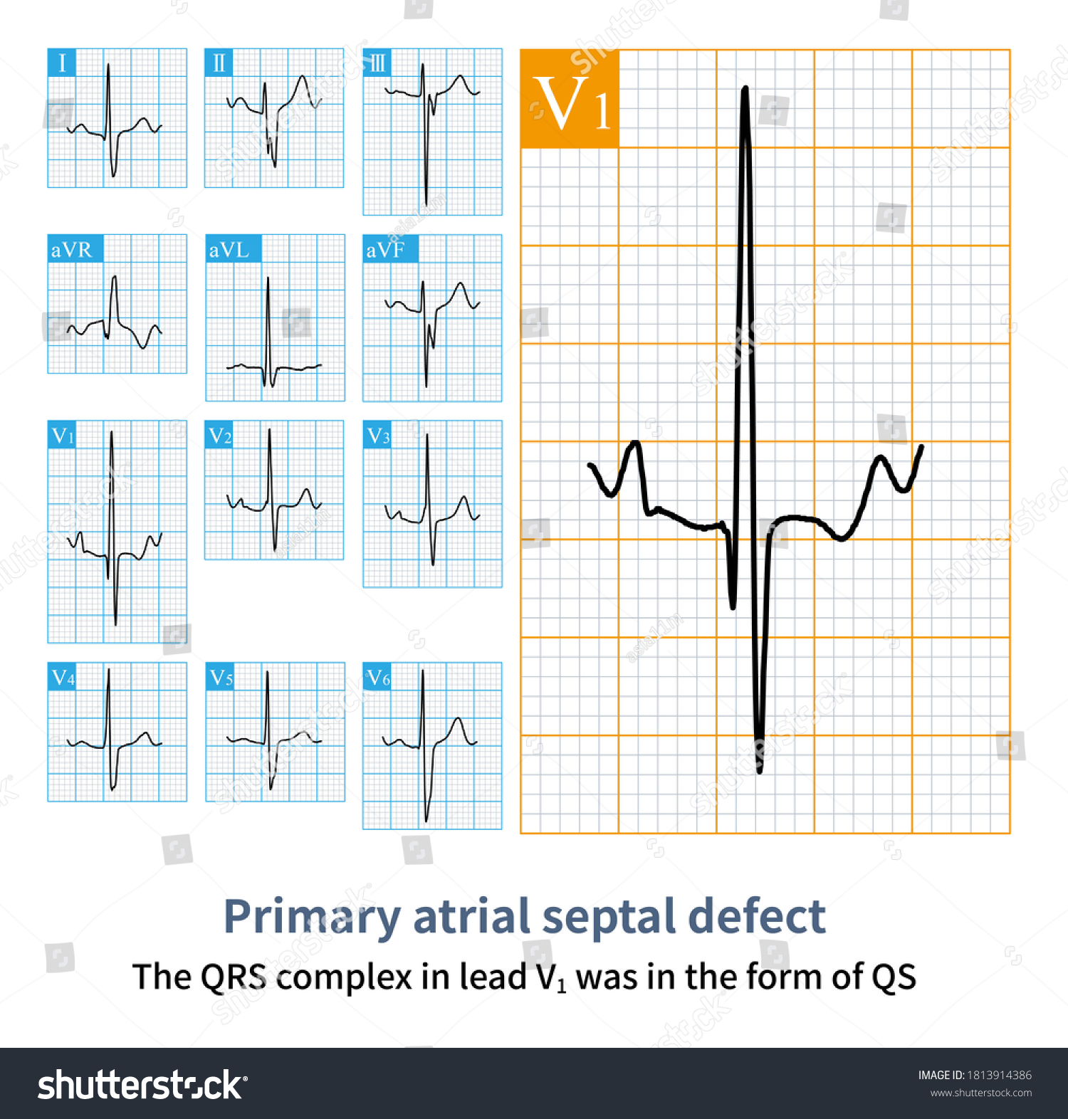 Electrocardiogram Patient Primary Atrial Septal Defect Stock ...