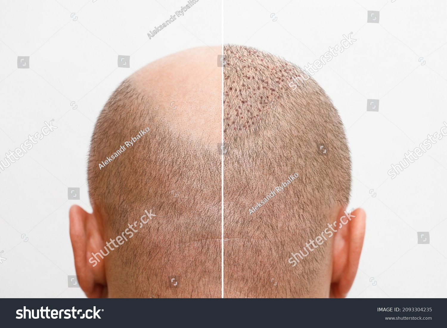 Head Balding Man Before After Hair Stock Photo (Edit Now) 2093304235