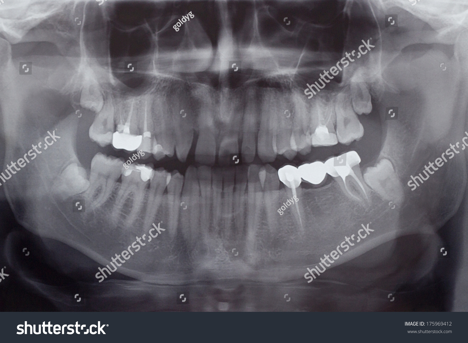 Human Teeth Xray Stock Photo 175969412 - Shutterstock