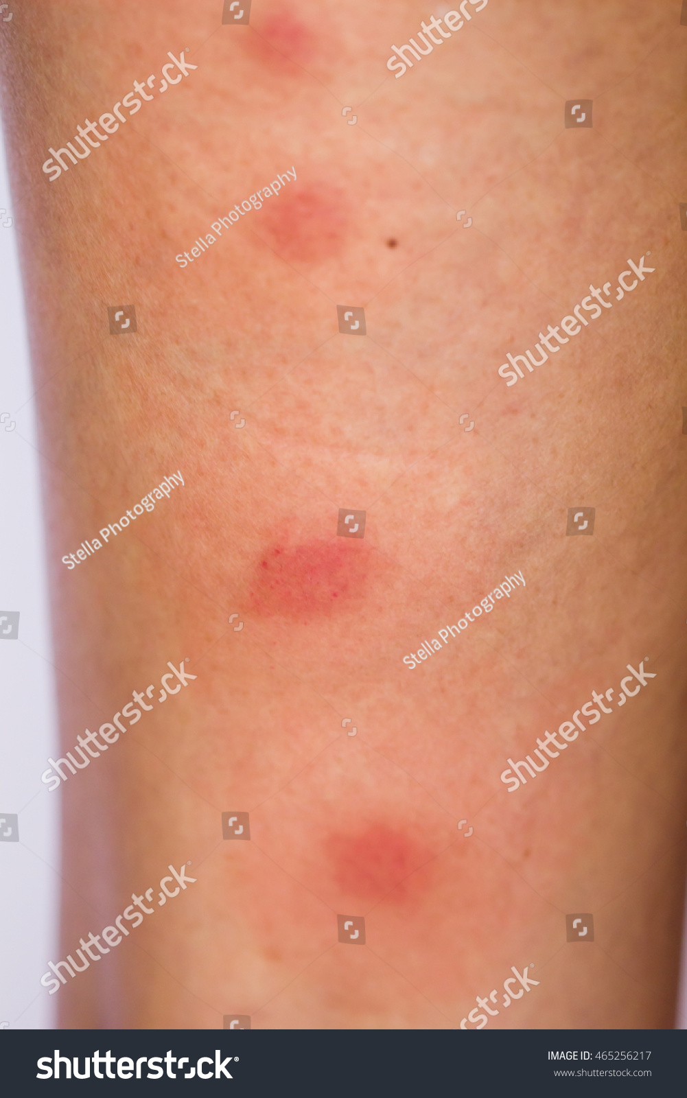 leg-red-spot-caused-by-insect-stock-photo-465256217-shutterstock