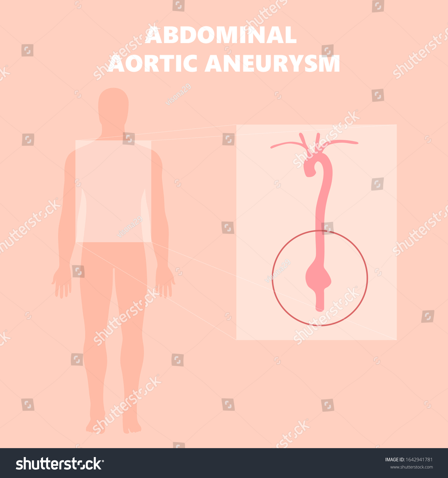 Medical Illustration Human Body Abdominal Aortic ภาพประกอบสต็อก 1642941781 Shutterstock 2711