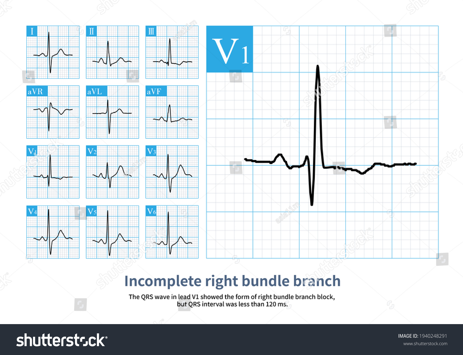 Qrs Wave Lead V1 Form Right Stock Illustration 1940248291