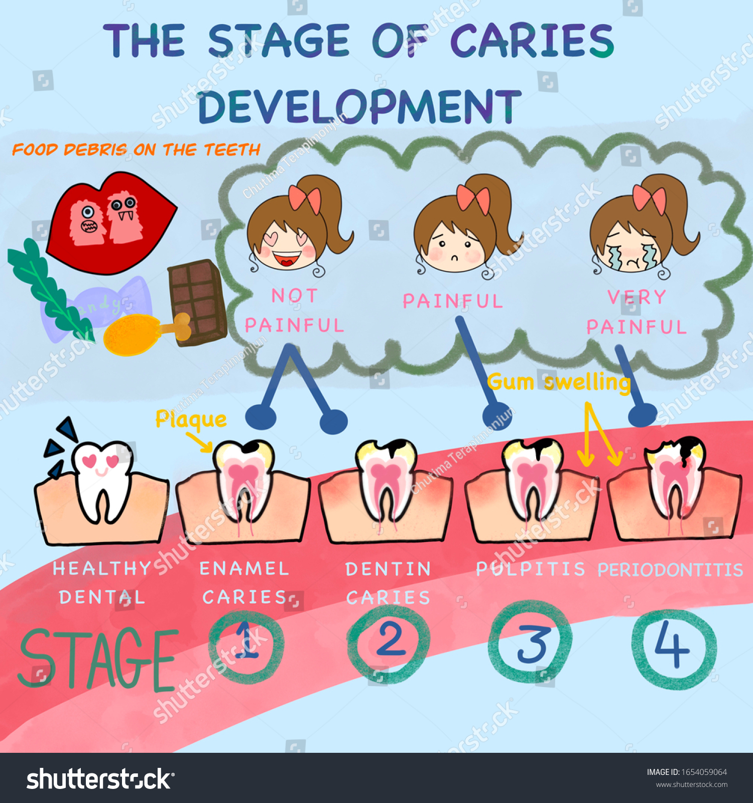 Stage Caries Development Stock Illustration 1654059064 2769