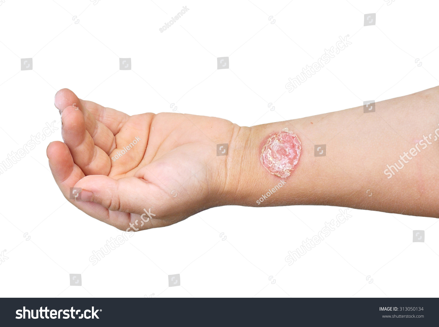 How to treat streptoderma 44 How to treat streptoderma 10