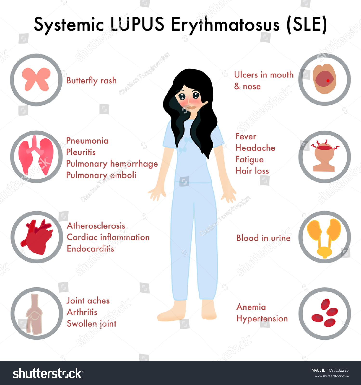 Symptoms Systemic Lupus Erythematosus Sle Including Stock Illustration