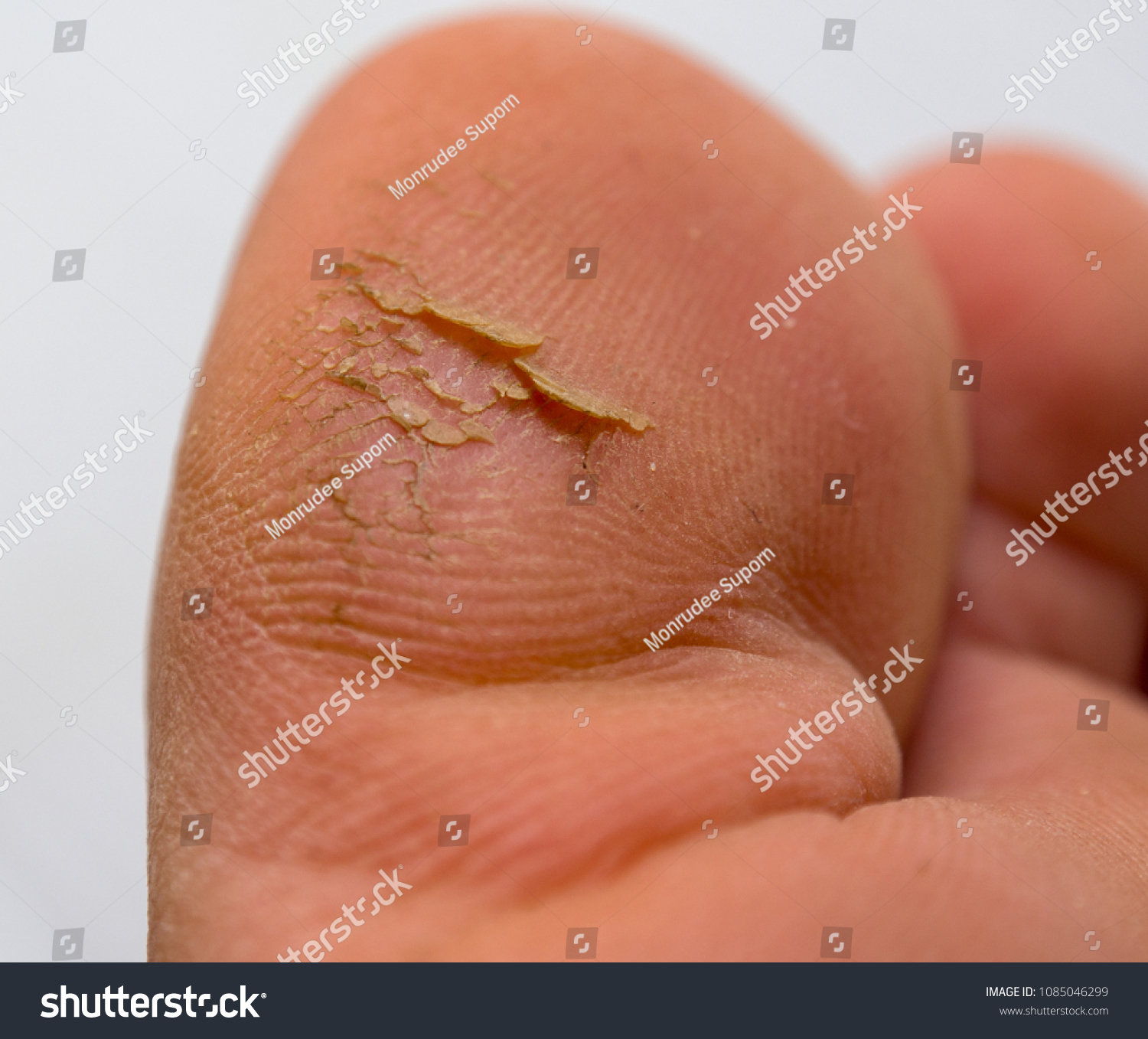 cracked toes