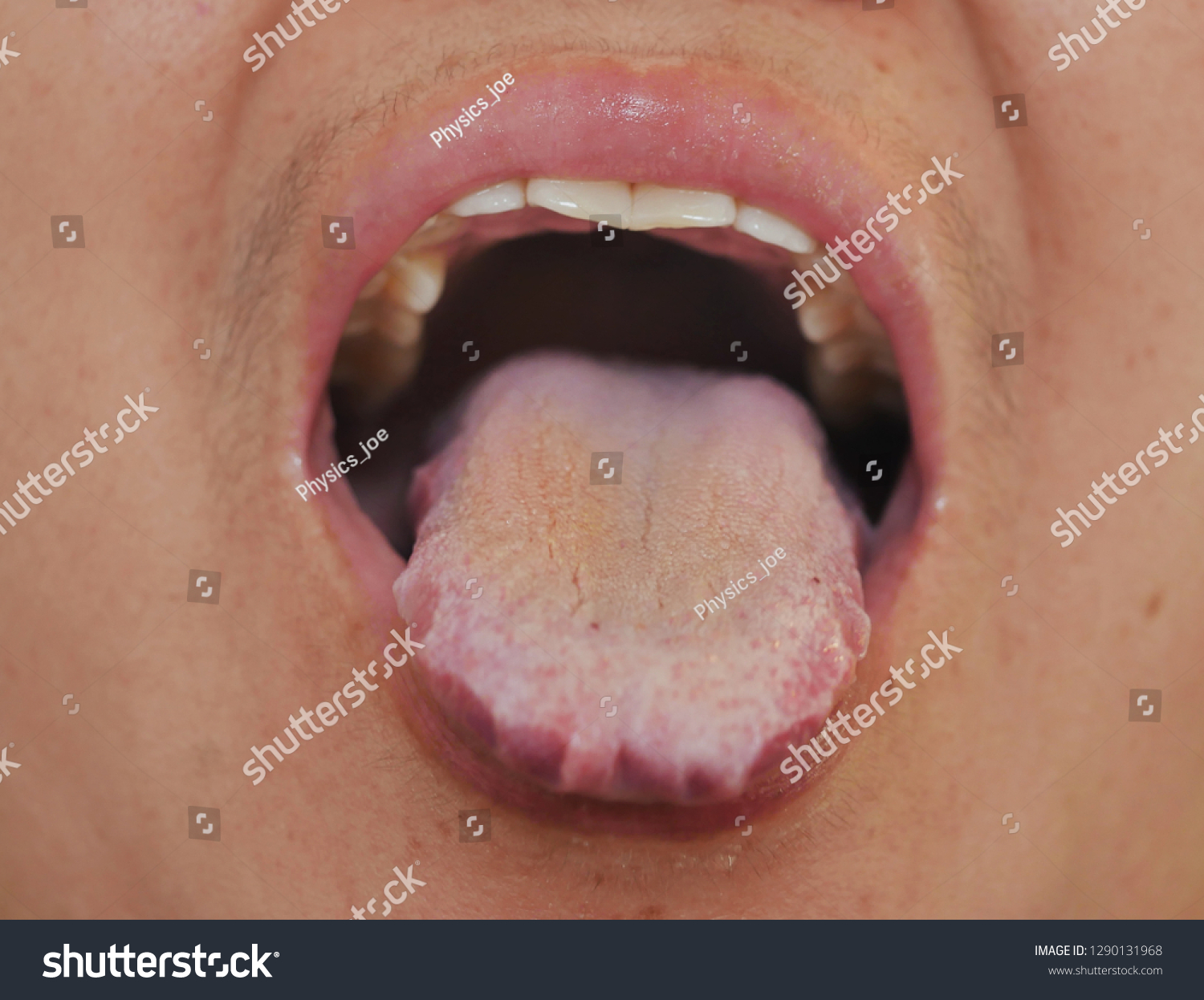 candida albicans mouth