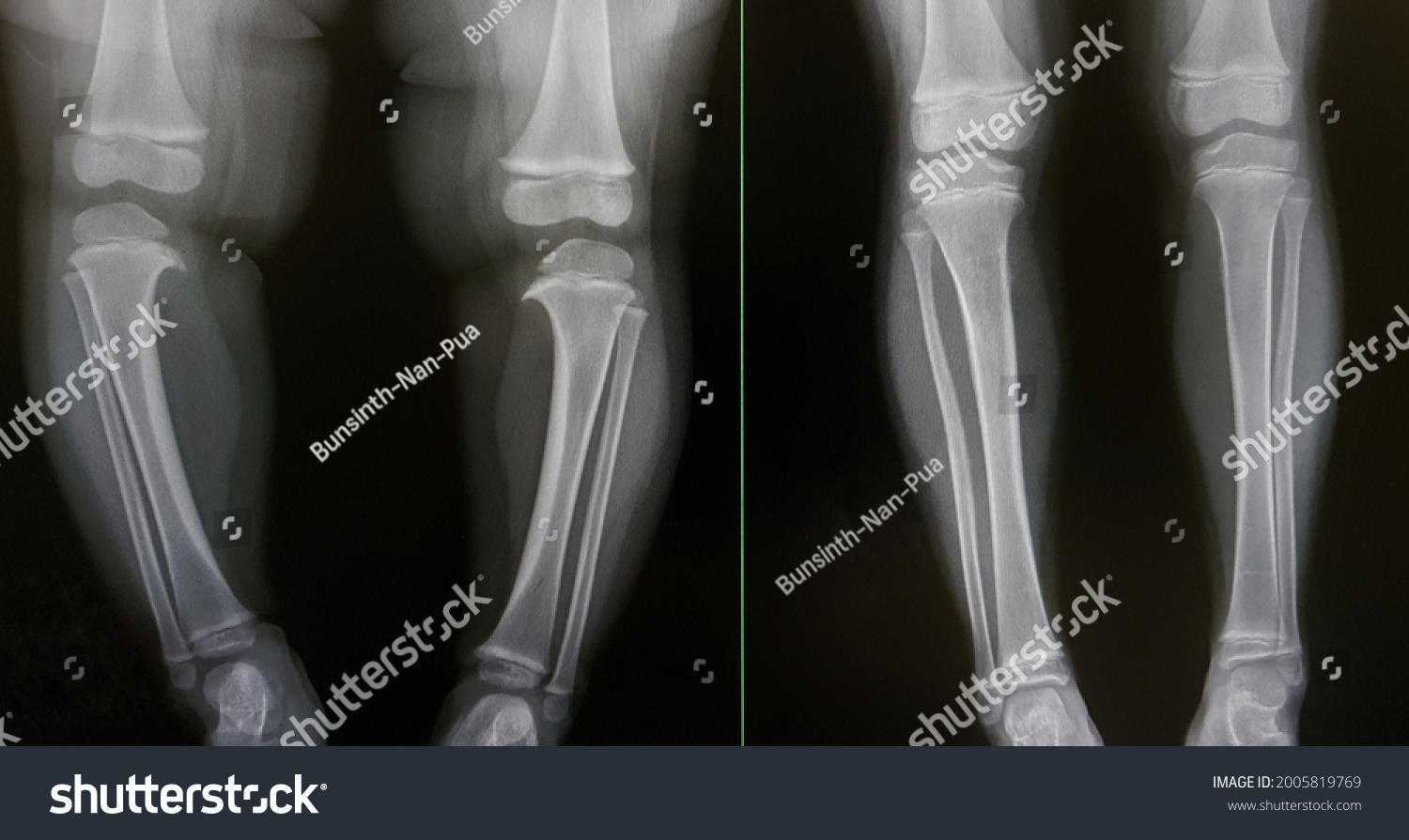 2 Pre tibial Images, Stock Photos & Vectors | Shutterstock