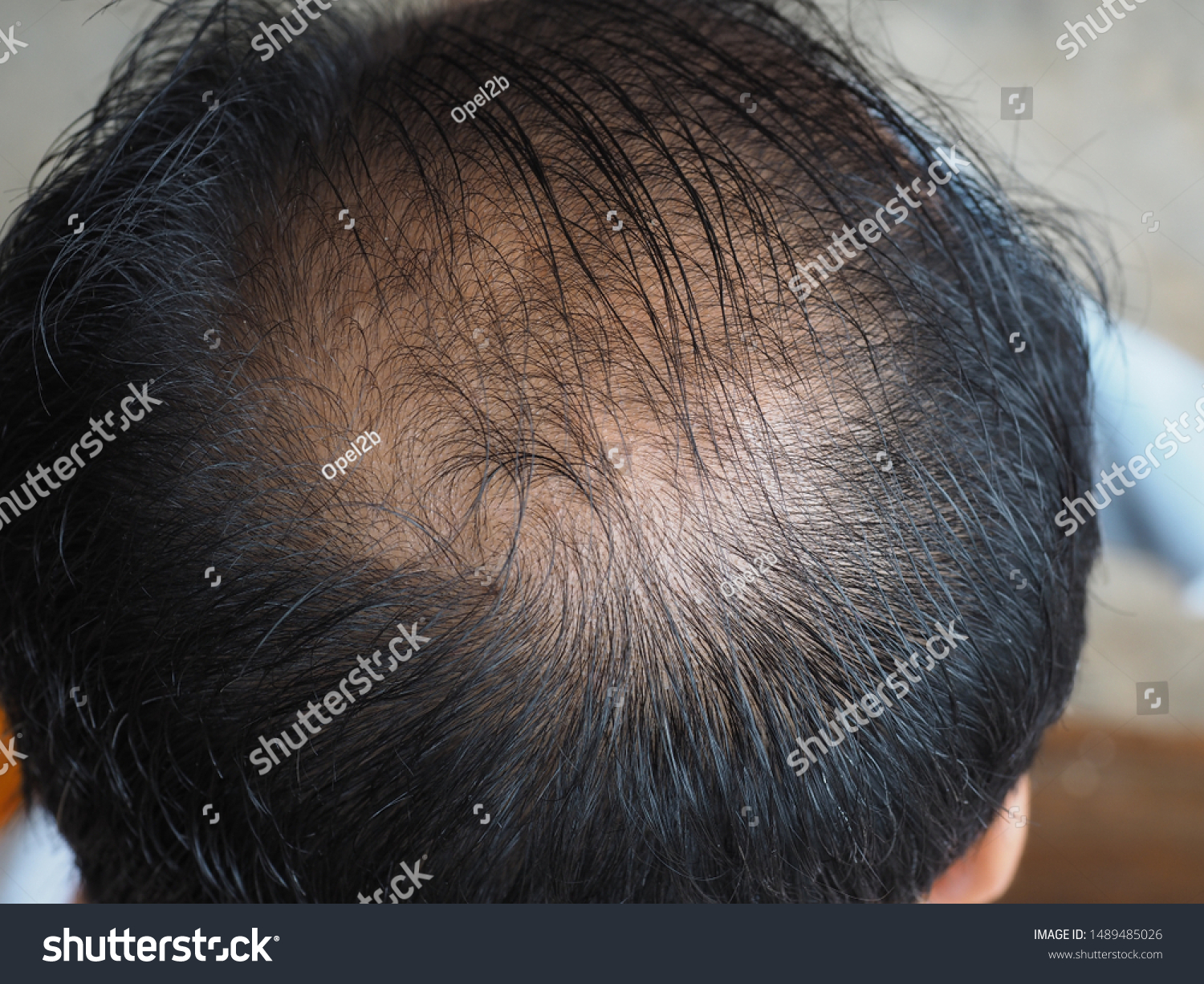 Thin Hair Scalp Broken Hair Stock Photo Edit Now 1489485026