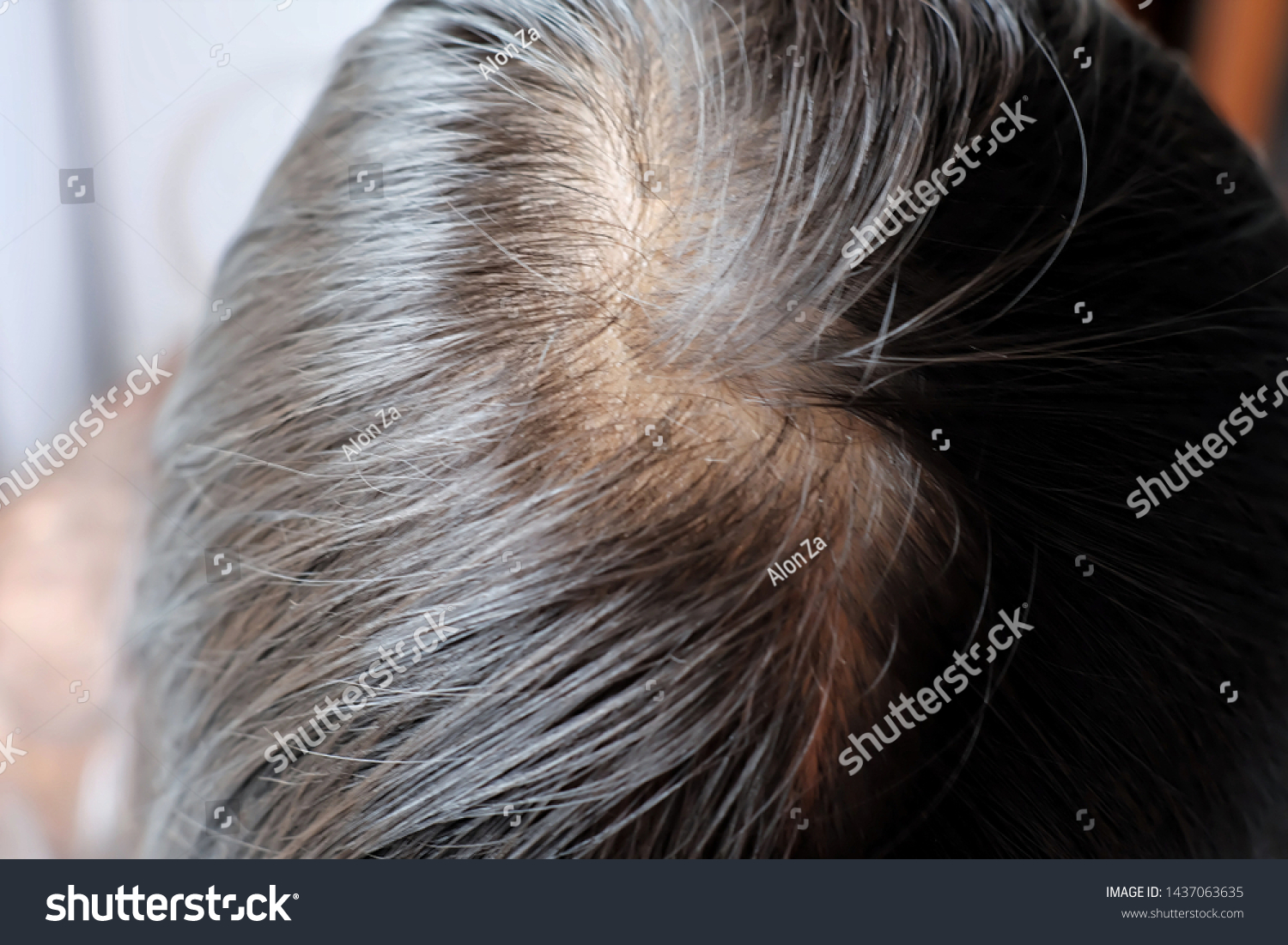 Thinning Hair Sealp Issue Hair Loss Beauty Fashion Healthcare