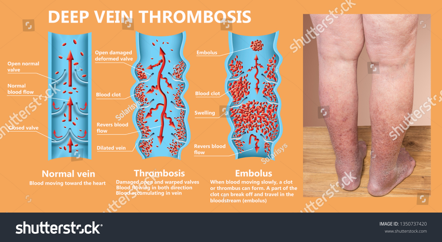 thrombosis-normal-blood-flow-blood-clot-h-nh-minh-h-a-c-s-n