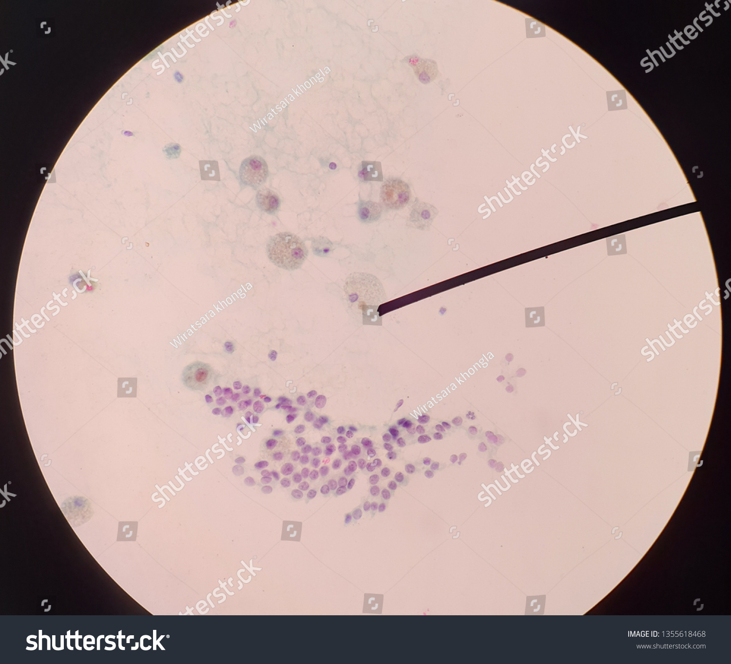 Thyroid Glands Hemosiderin Laden Macrophages Follicular Stock Photo Edit Now 1355618468