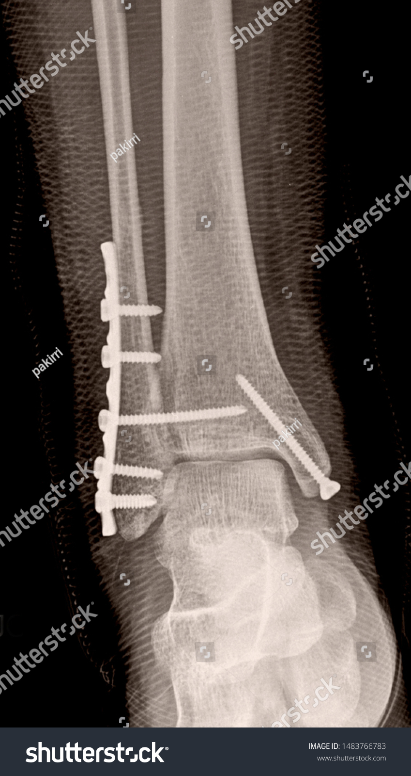 Tibia Perone Fracture Xray Stock Photo (Edit Now) 1483766783