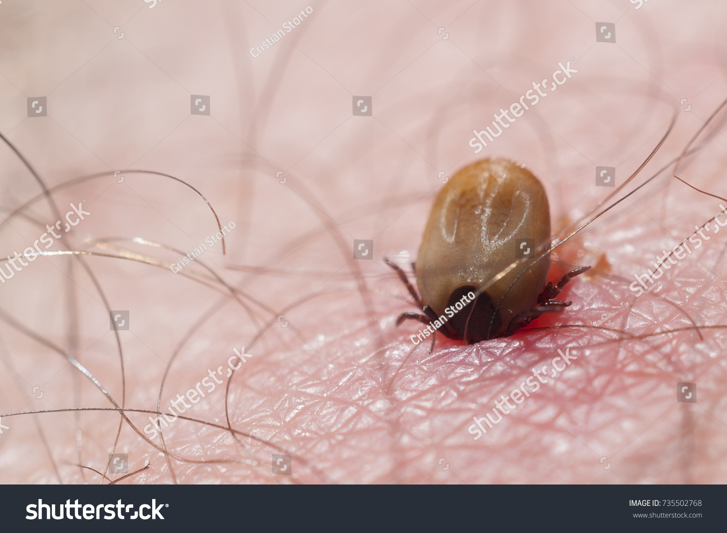 Tick On Human Skin Stock Photo 735502768 | Shutterstock