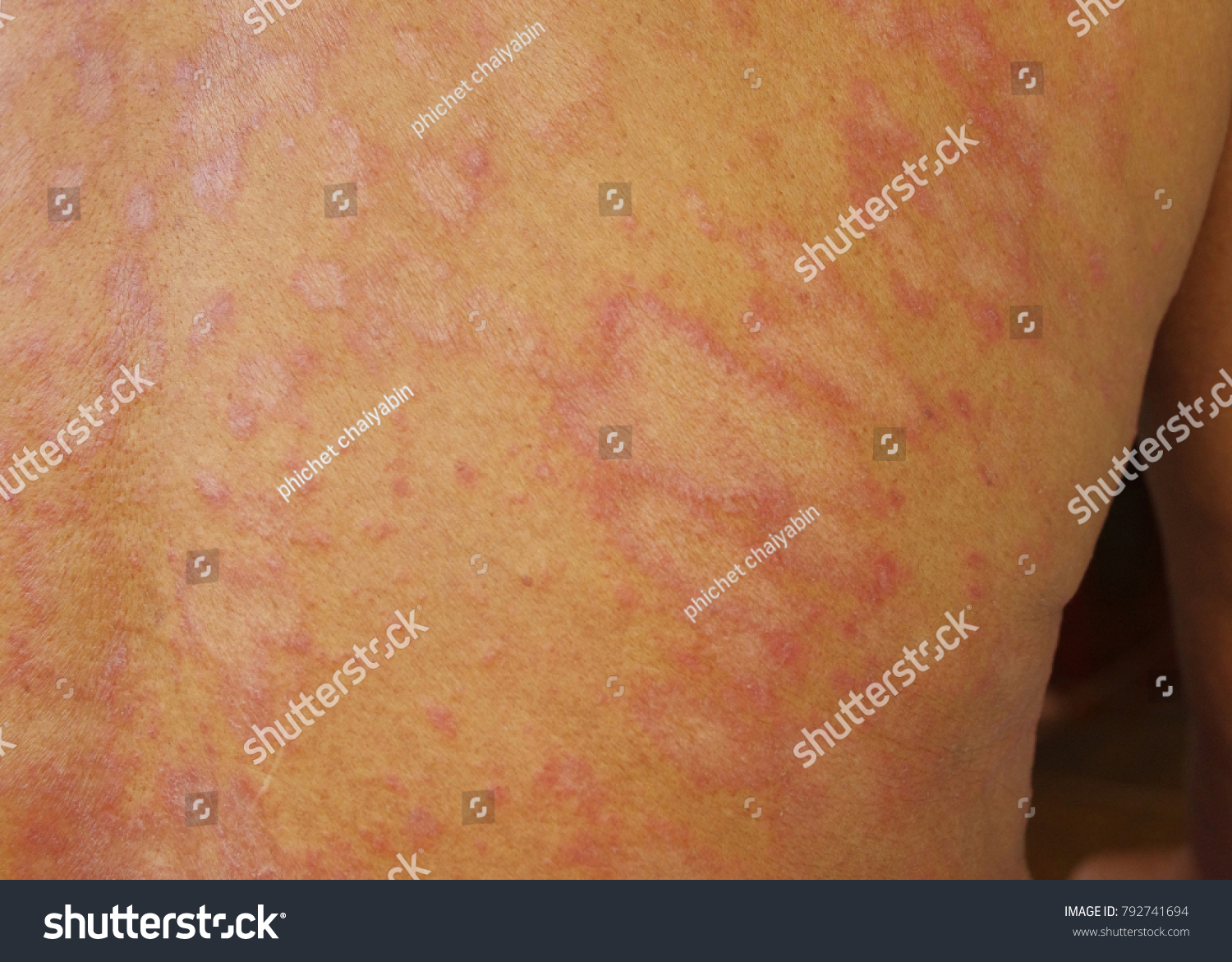 Zdjęcie Stockowe „tinea Corporis Fungal Infection Mycosis” 792741694 Shutterstock 7341