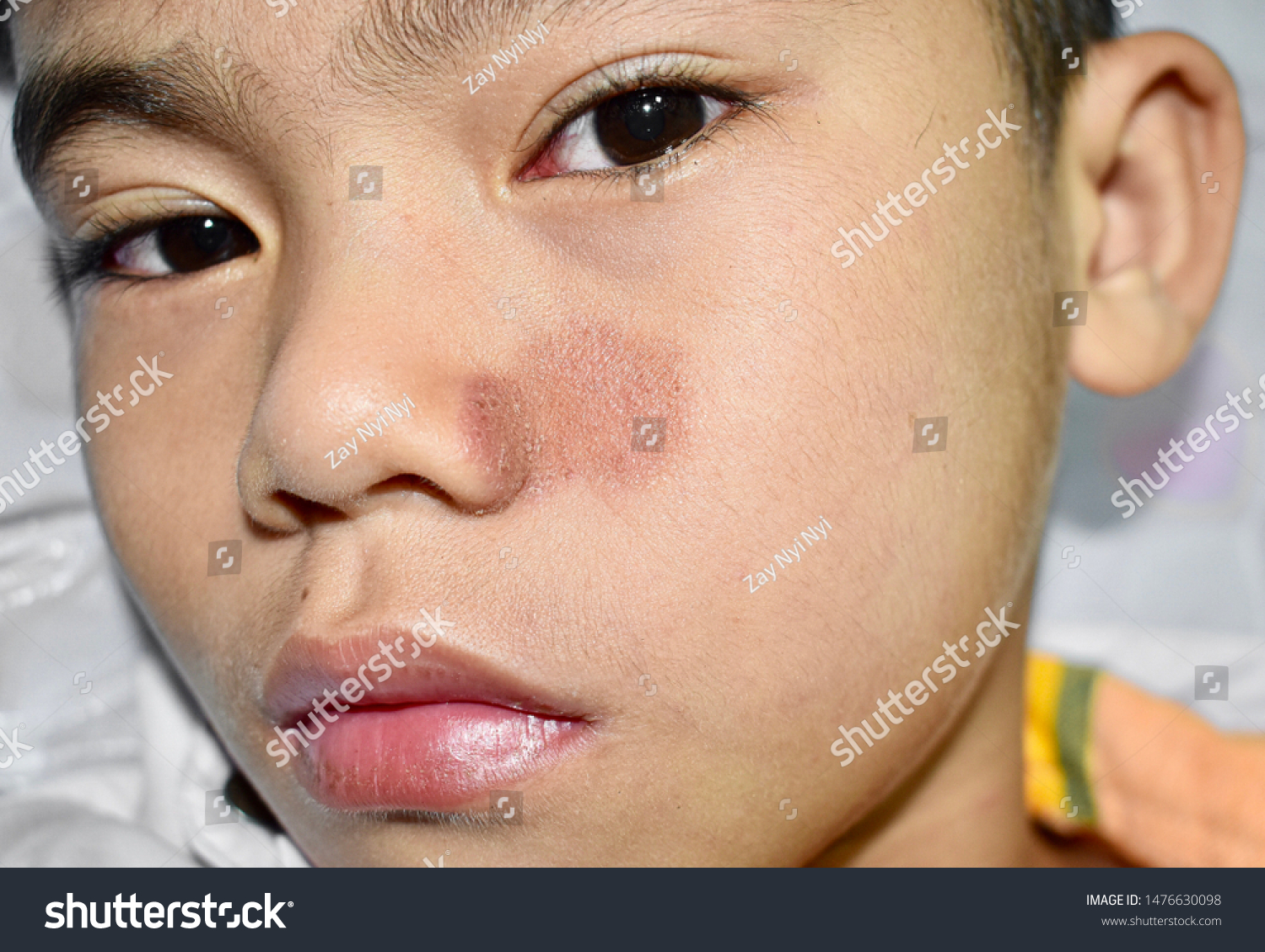 Tinea Faciei Fungal Infection On Face Stock Photo Edit Now 1476630098