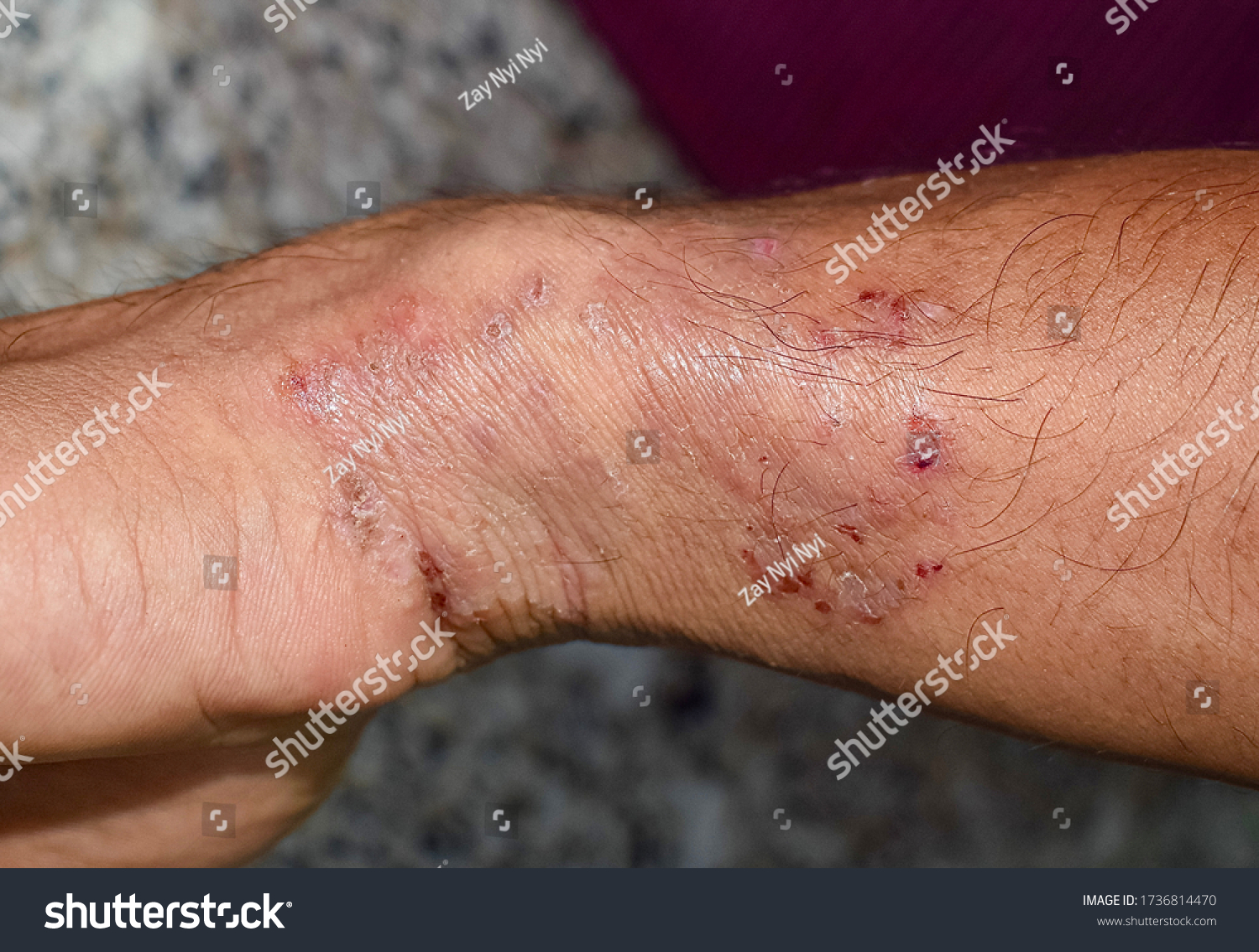 Tinea Manus Fungal Infection On Wrist Stock Photo (Edit Now) 1736814470 ...