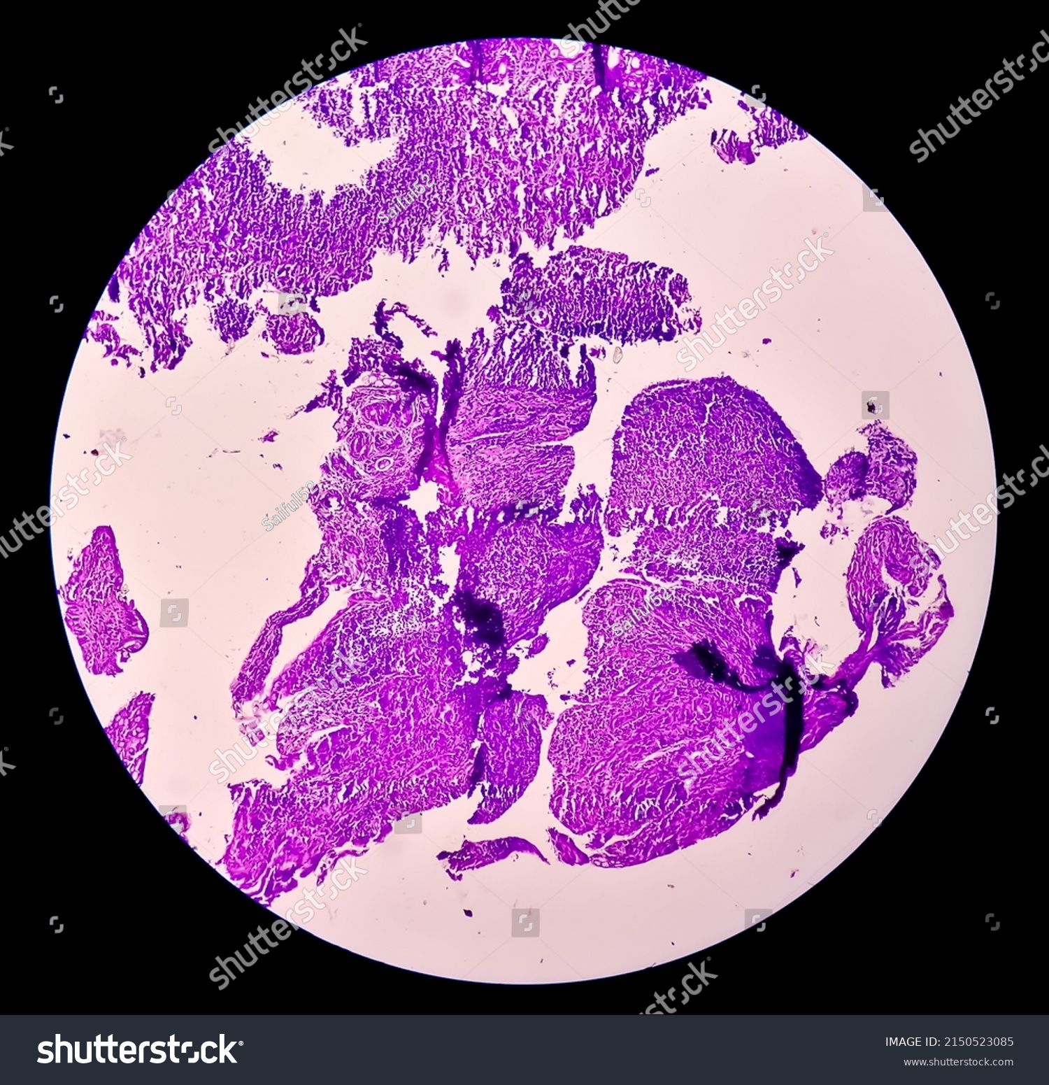 Tissue Terminal Ileum Chronic Nonspecific Ileitis Stock Photo ...